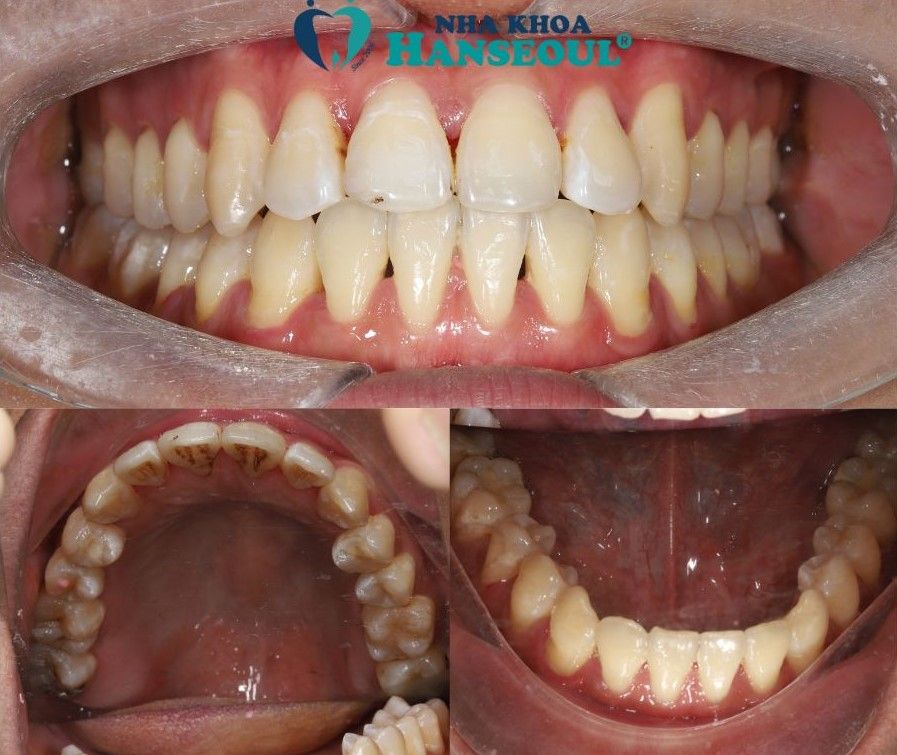 Ca niềng răng khớp cắn ngược của Phan Thanh Phương (2001)